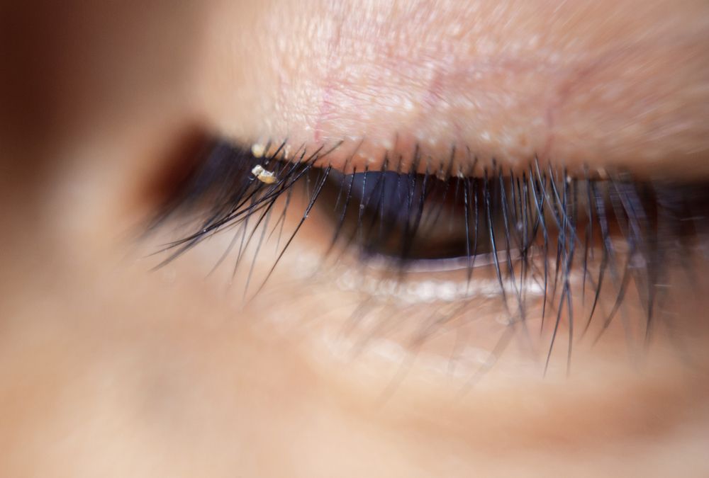 Effective Ways to Remove Eyelash Mites